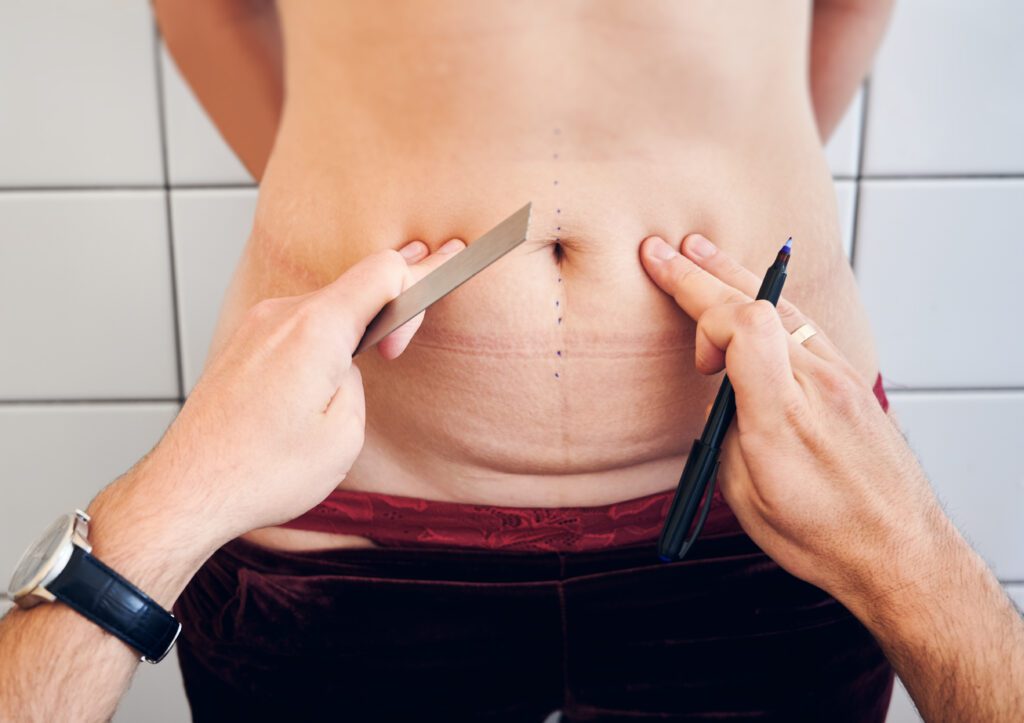 Tummy Tuck - COSMED At Home